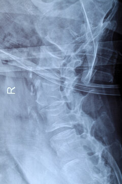 spine of a human body on x-ray