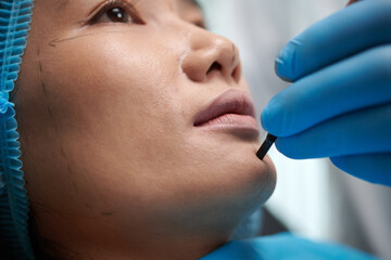 Closeup image of plastic surgeon marking face of patient before chin filler injection