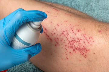 The doctor's hand applies disinfectant foam to the leg. A doctor treats a cyclist's leg injury who fell off his bike with disinfectant foam and cotton.