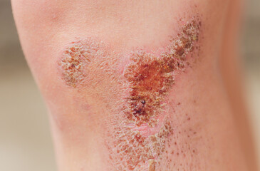 two scratch wound on female knee with big scar closeup, healthcare and medicine concept.