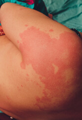 Urticaria or hives on the back, on the shoulder red rashes, itchy bumps .