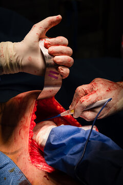 Medical team during hernia operation on patient body