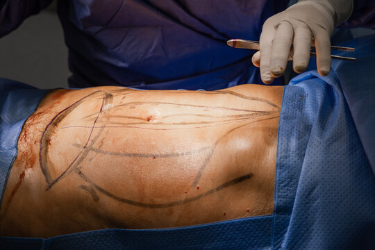 Male surgeon carefully marking patient body