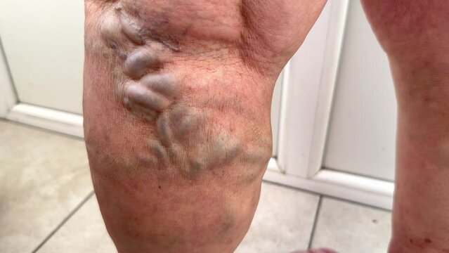 Varicose veins with dark colored wide thrombosed veins under the knee of a female leg in the clinic. Problems with vascular health. Thrombosis on female legs. Venous disease, thrombophlebitis. Phlebol