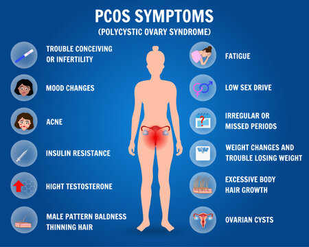Polycystic ovary syndrome gynecology information in vector, pcos symptoms 