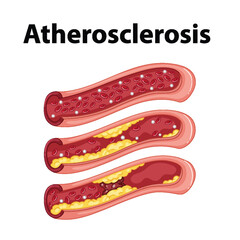 Science Education: Human Anatomy and Atherosclerosis Infographic