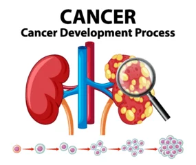 Foto auf Acrylglas Kinder Cancer Development Process on Human Kidney: An Infographic