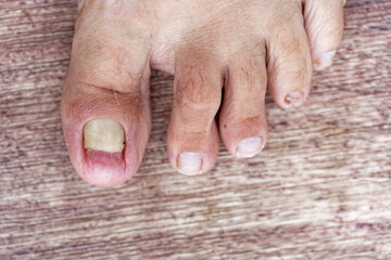 close up of broken toe nail infected by bacteria and fungus