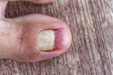 close up of broken toe nail infected by bacteria and fungus