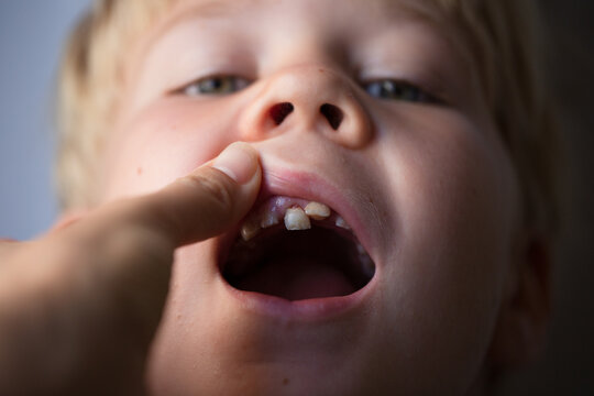 boy 7 years old with a tooth that will fall out soon