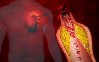 Hyperlipidemia or arteriosclerosis. Blocked artery concept and human blood vessel as a disease with cholesterol fat buildup clogging. Clogged arteries, Cholesterol plaque in the artery. 3D Rendering