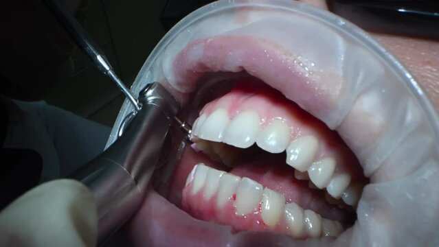 Dental Extreme Close up Macro Video. Cleaning process in patient's mouth. Clean teeth with water jet and saliva ejector. Concept of professional dental hygiene. 4k 120 fps slow motion raw footage