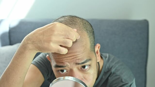 Asian man having stress about his hair loss problem. Baldness is related to your genes and male sex hormones.