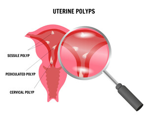 Uterine polyps infographic, womans health, medical disease, sessile polyp, pediculated polyp, cervical polyp