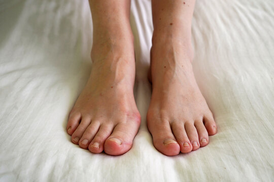 female legs with problem with women's feet, bunion toes in bare feet. Hallus valgus
