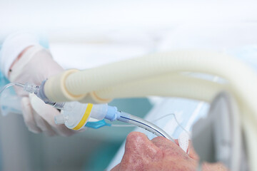 Breathing tube in patient's mouth during surgery. Anesthesia before surgery.An elderly man in...