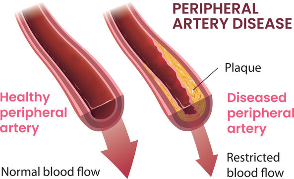 illustration of peripheral artery disease infographic vector