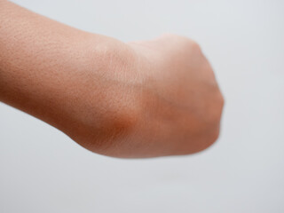 ganglion cyst on woman hand isolated on white background