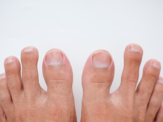 Toes with nail disease isolated on a white background