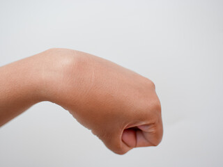 ganglion cyst on woman hand isolated on white background