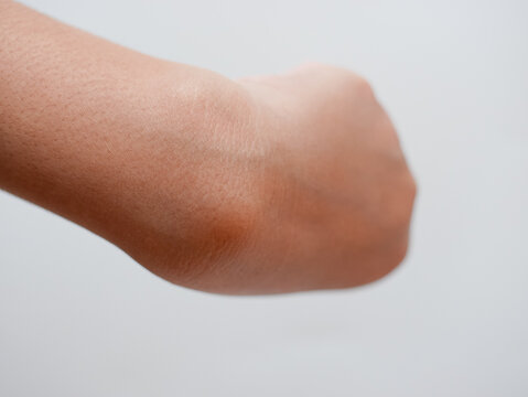 ganglion cyst on woman hand isolated on white background