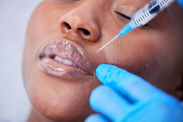 Plastic surgery, needle and black woman with lip filler closeup on a hospital bed with dermatology....