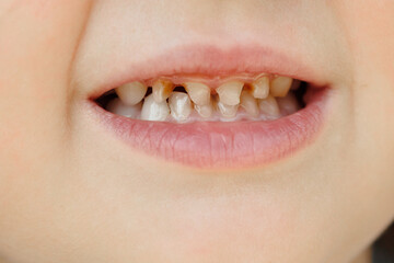 Children's milk teeth with caries. Close-up of unhealthy milk teeth. Dental medicine and healthcare...
