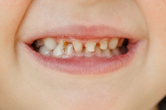 Children's milk teeth with caries. Close-up of unhealthy milk teeth. Dental medicine and healthcare - patient's open mouth showing caries. Children's dentist.