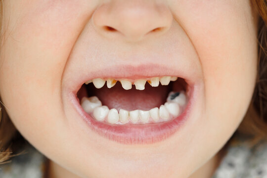 Children's milk teeth with caries. Close-up of unhealthy milk teeth. Dental medicine and healthcare - patient's open mouth showing caries. Children's dentist.