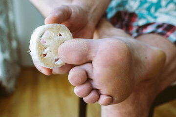 Man taking care dry cracked skin legs