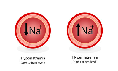 Hypernatremia, high plasma sodium level and Hyponatremia, low plasma sodium level. Sodium Na excess and deficit electrolyte disorders, blood test tube, Scientific design. Vector illustration.