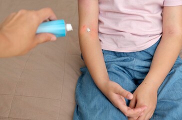 The child applies a special cream to atopic skin. Dermatitis, diathesis, allergy on the child's...