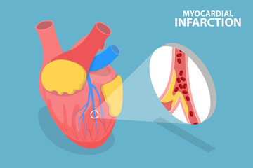 3D Isometric Flat Vector Conceptual Illustration of Myocardial Infarction, Heart Attack
