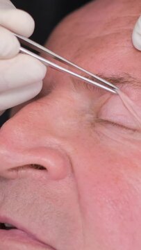 Close-up, examination of the face of an old man before plastic surgery to change the eye area