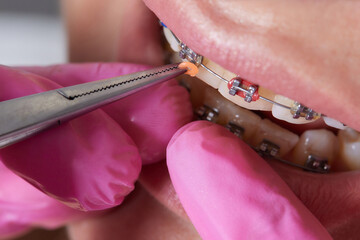 Dental procedure for installing braces close up.The procedure for the care of teeth and gums in the...