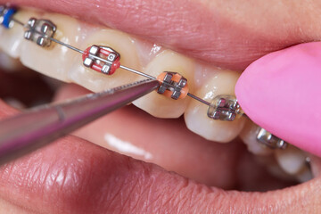 Dental procedure for installing braces close up.The procedure for the care of teeth and gums in the...
