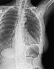 Costal x-ray of coast sternum and clavicle