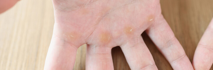 Fototapeta premium Calluses or corns on palmar surface of hand.