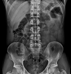 Diagnostic medicine, x-ray image of the abdomen