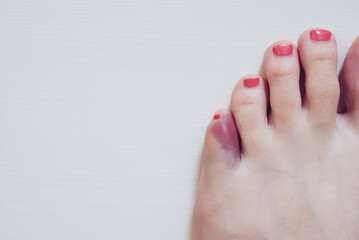 Foot with broken pinky toe caused by forceful impact with furniture. Baby toe fracture and...