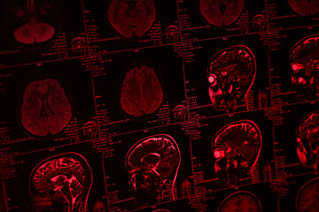 MRI or magnetic resonance imaging of the head and brain in red light. Close-up