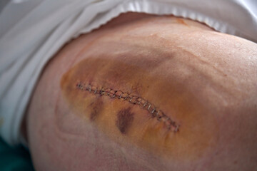 Leg of unrecognizable patient with stitches
