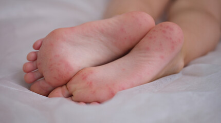 Eczema is an irritation caused by an allergic lesion of skin of feet in child. Infectious skin...