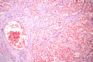 Capillary hemangioma, light micrograph