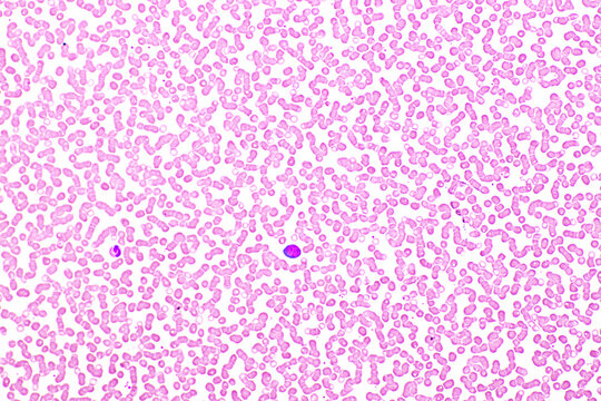 Red blood cells and white blood cells in blood smear, Wright-Giemsa stain, analyze by microscope, 10x