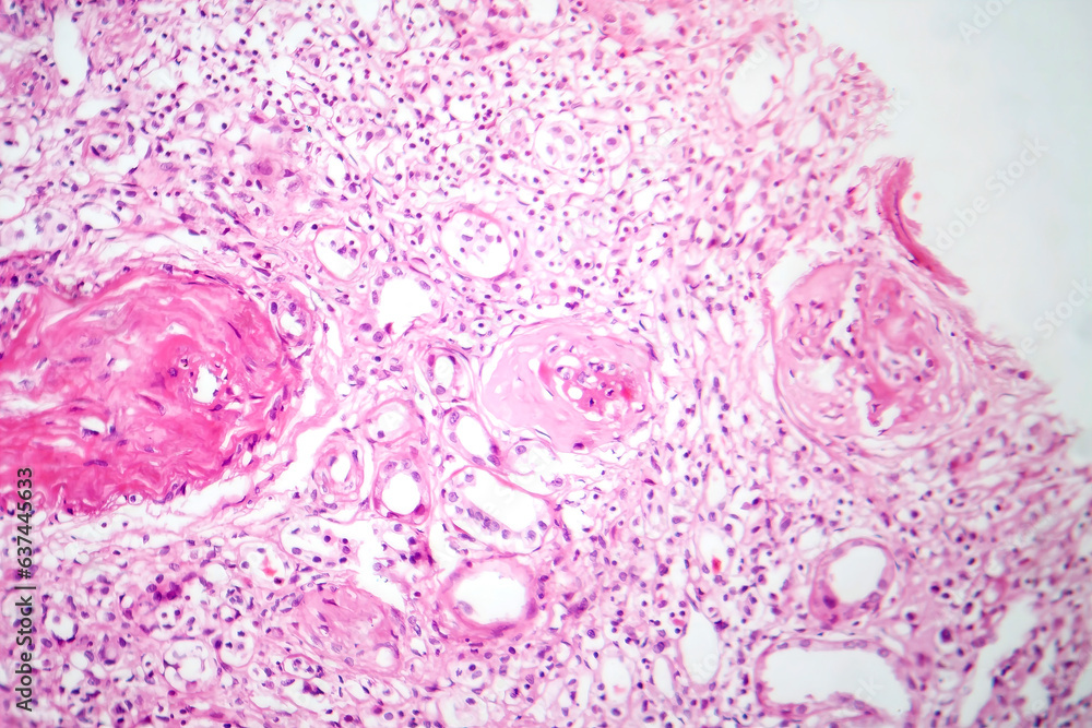 Wall mural primary particulate contracted kidney, light micrograph