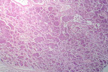 Lobar pneumonia in grey hepatic phase, light micrograph