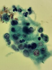 Blastomyces fungal organisms in skin biopsy specimen