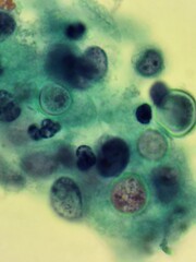 Blastomyces fungal organisms in skin biopsy specimen