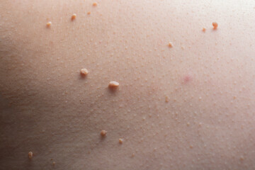 Several warts on the body close-up.